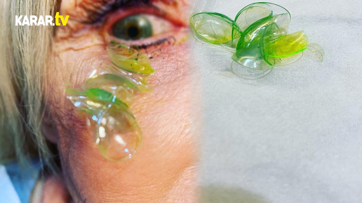 ABD'de inanılmaz olay! Hastanın gözünden 23 adet kontak lens çıkartıldı