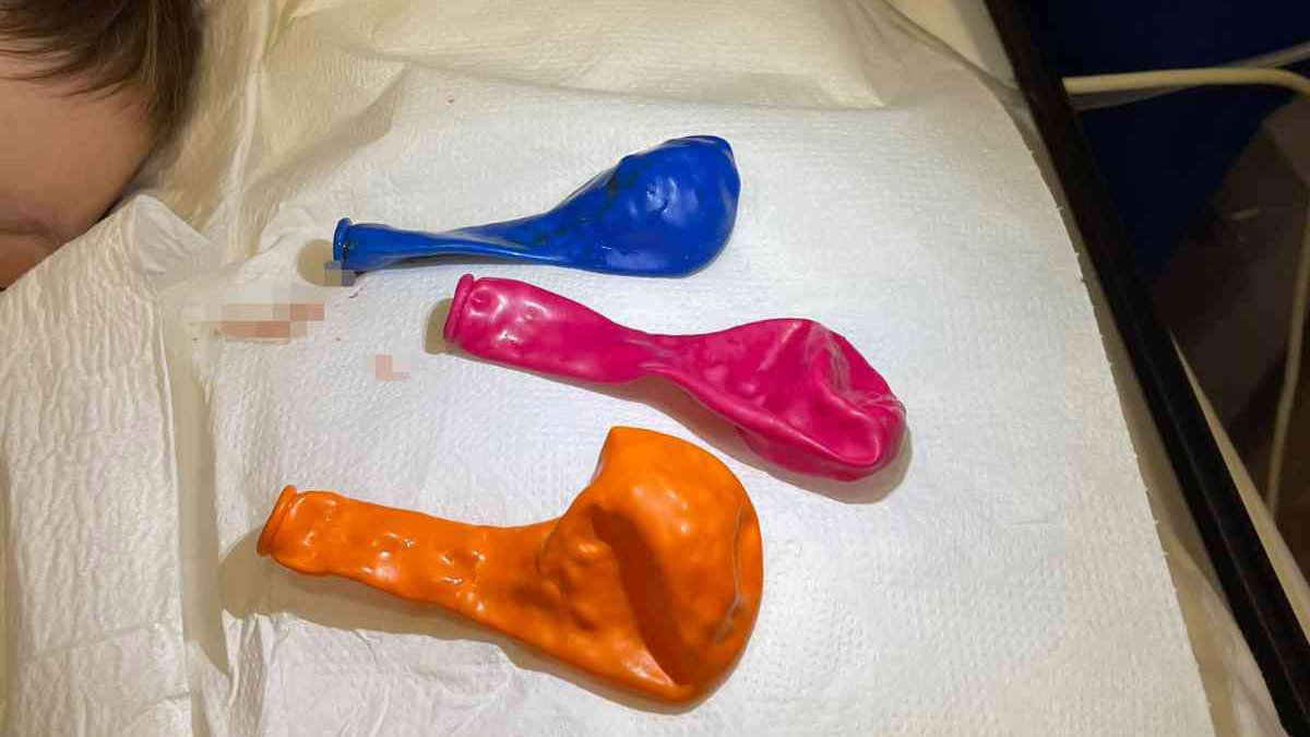 Akılalmaz olay! 1 yaşındaki bebeğin midesinden 3 tane balon çıktı