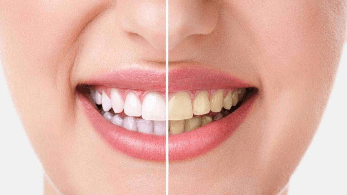 Evinizdeki doğal malzemelerle dişlerinizi kolayca beyazlatın rahatça gülümsemenin tadına varın!