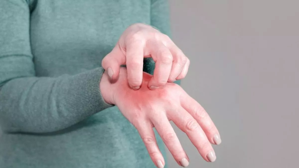 Uzmanlardan uyuz uyarısı: Türkiye'de salgın şeklinde