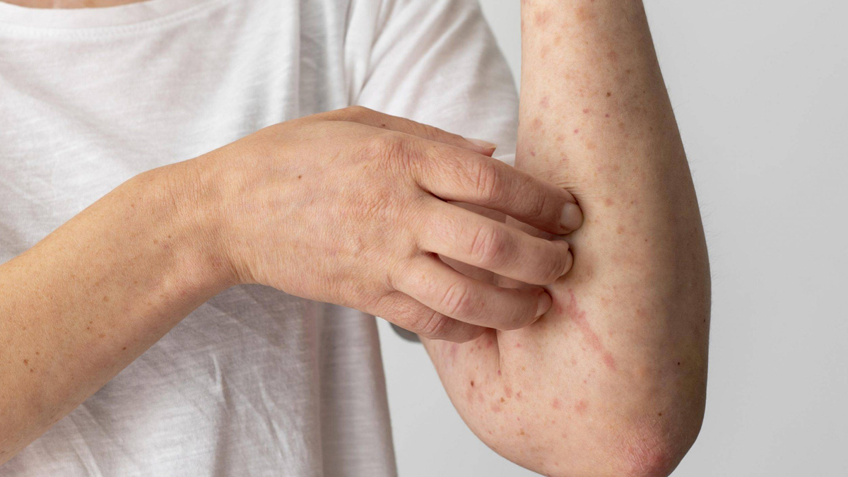 Kene ısırığı ardında kırmızı et alerjisi bırakabiliyor