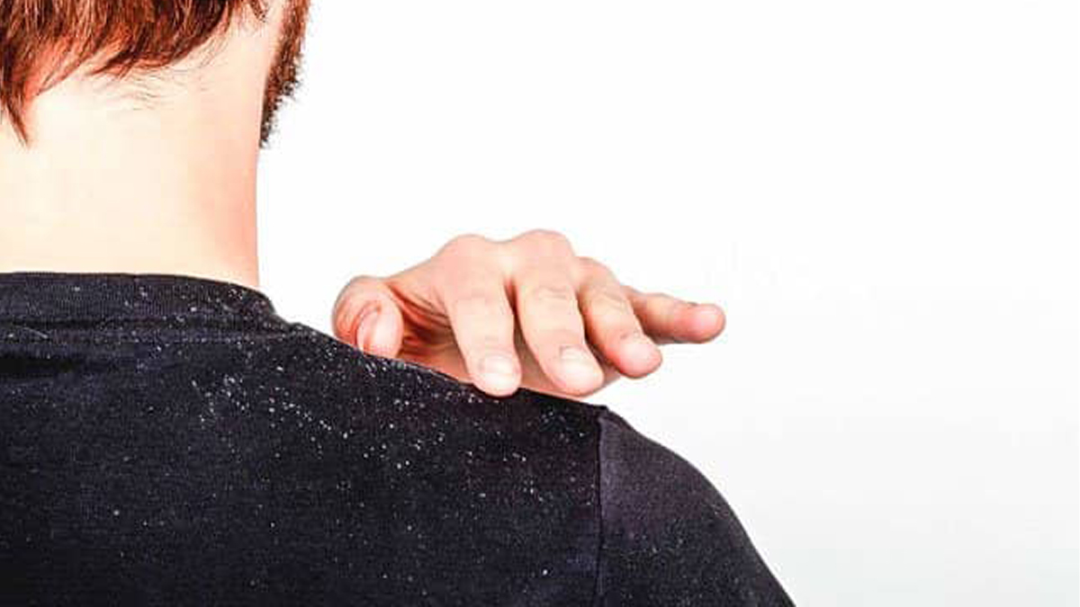 Kepekten sorunundan sıkılanlara doğal basit çözümler! Bu basit yöntemle kepek sorunu tarih oluyor