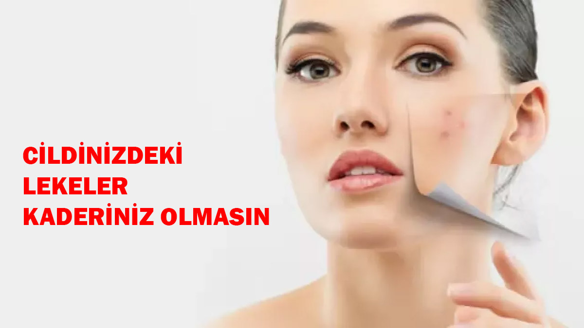 Bu 3 doğal ev ilaçları ile lekelere güle güle deyin! Temiz bir cildin tadını çıkarın!