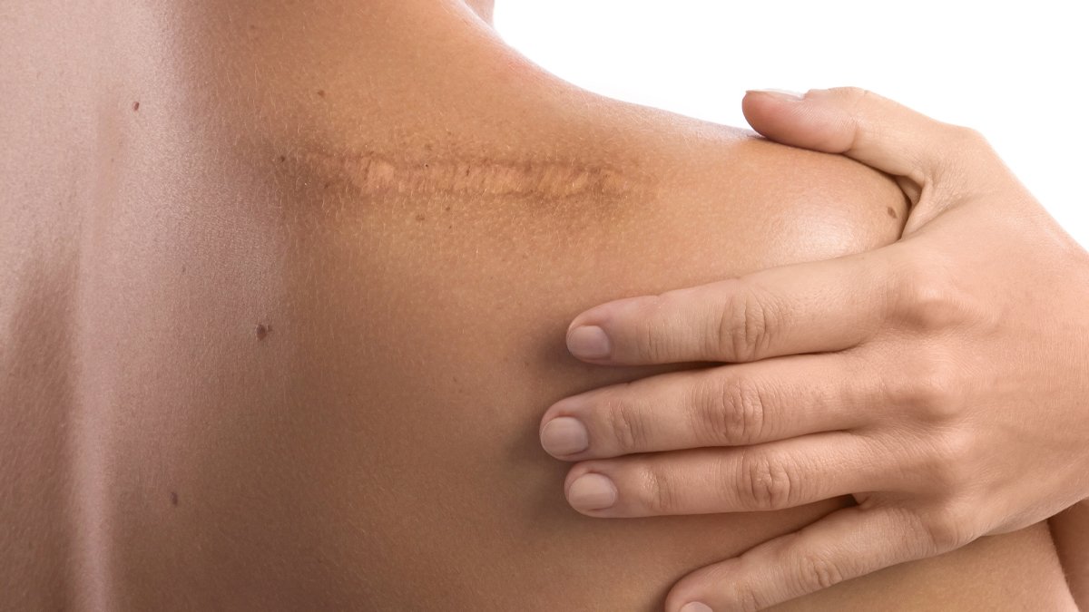 Eski yara izlerinden sonsuza kadar kurtulun... Cildinizdeki eski yara izleri nasıl yok edilir?