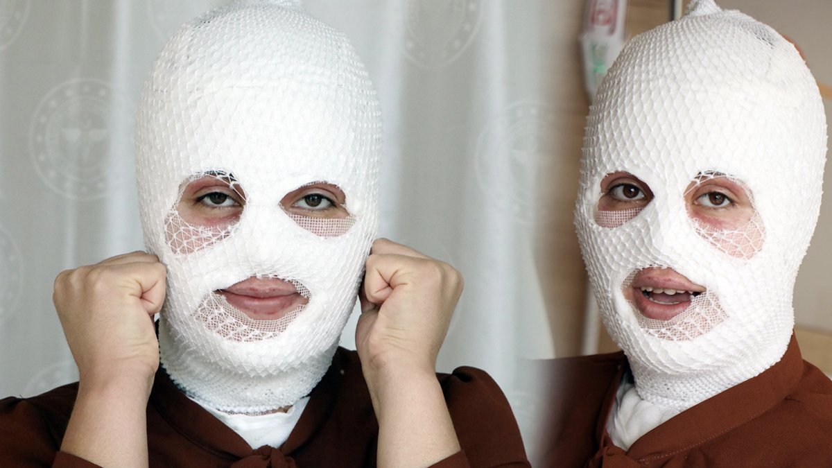 Yemek yapıyordu, dehşeti yaşadı! 'Yüzümdeki derinin döküldüğünü gördüm'