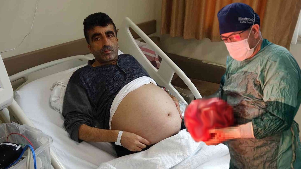 Karnından çıkanlar doktoru bile şoke etti: İki yıl boyunca bunlarla yaşadı
