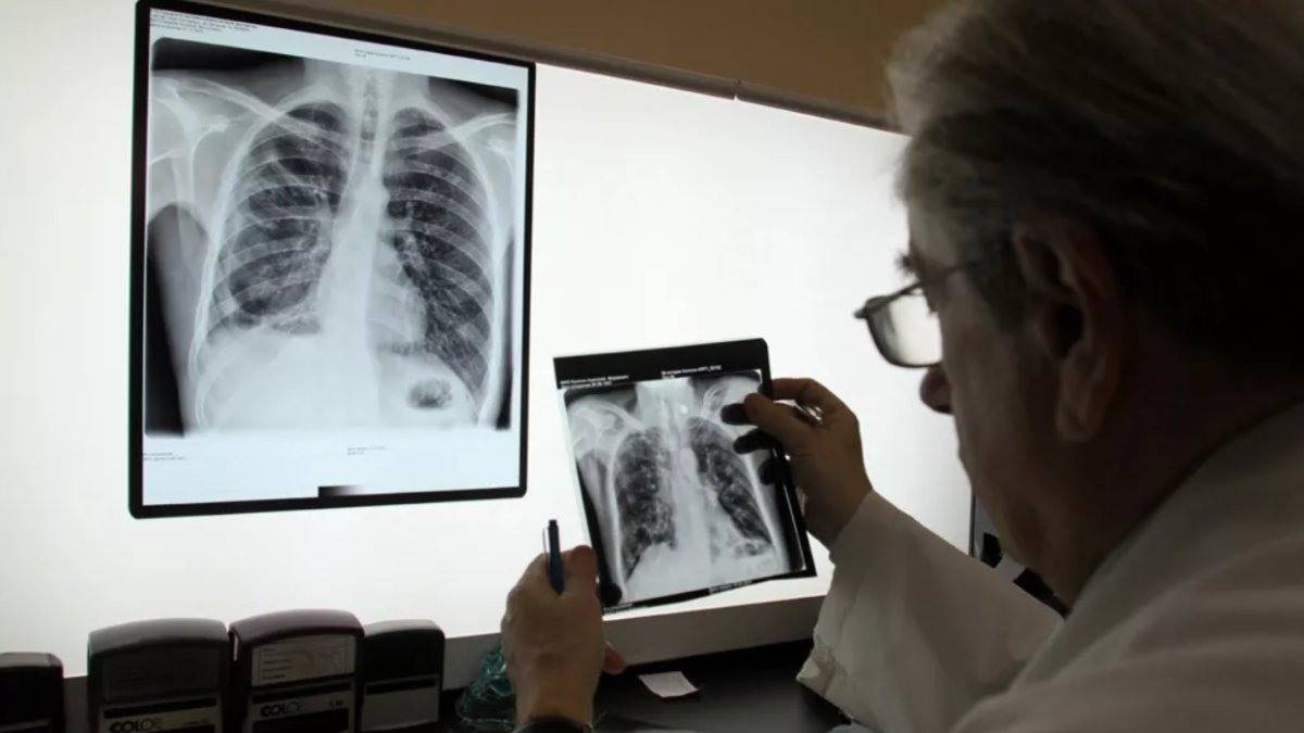 Uzman isim akciğerlere dikkat çekerek uyardı: Kovid sonrası kanser tehlikesi