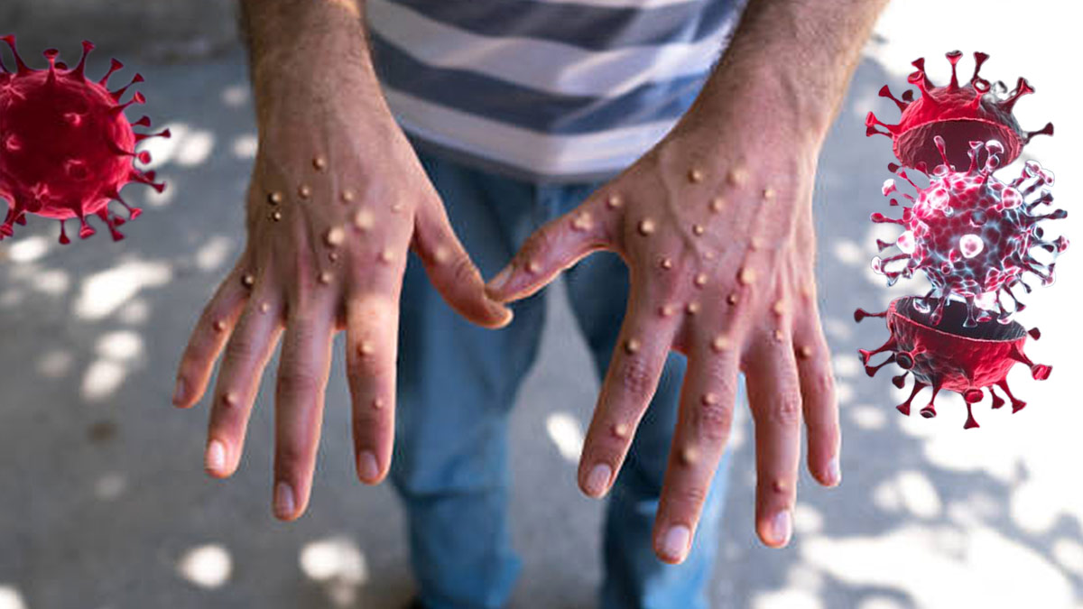 KKTC'de maymun çiçeği virüsü paniği