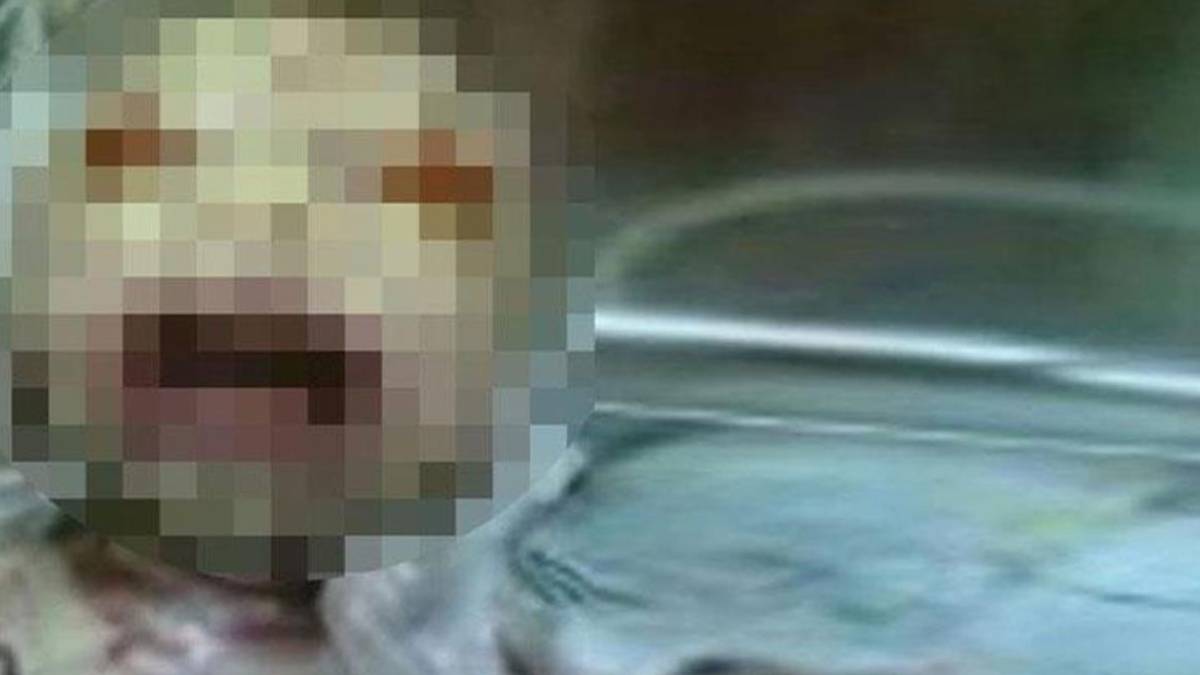 Allah kimsenin başına vermesin... Yılan kızın son hali görenleri korkuttu! 17 yaşına kadar geldi ama...