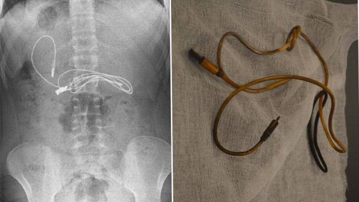 15 yaşındaki çocuğun midesinden çıkanlar şoke etti