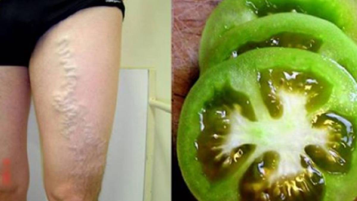 Bacağınıza domates sürün mucizevi etkisini anında görün! Terapistlerin gizli yöntemi ifşa oldu