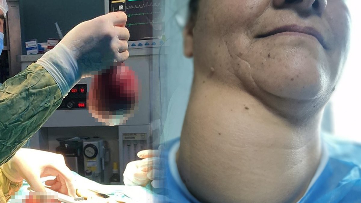 Ameliyat korkusu bu hale getirdi: Tam 800 gram!