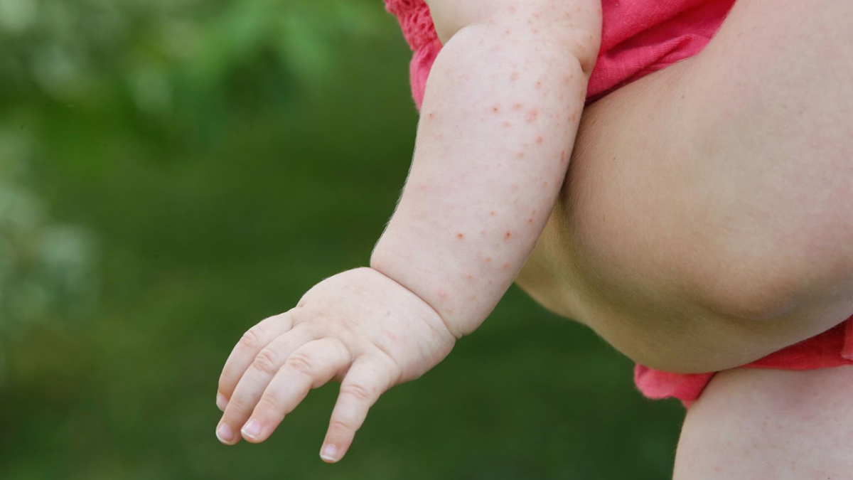 Çocuklarda Strep A'dan sonra yeni kabus: GAS