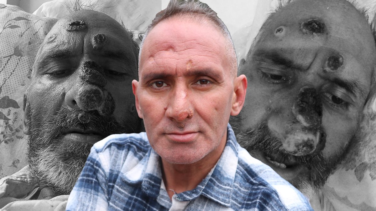 Bir 'ısırık' hayatını kabusa çevirdi: Vücudum  güç üretemiyor