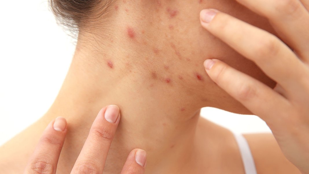 ABD'de kızamık alarmı: 20 bin kişi yakalanmış olabilir