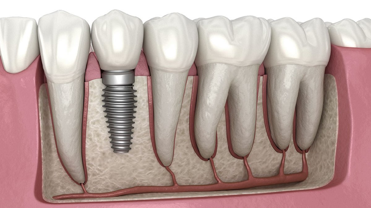 Eksik dişleri yerine implant yaptırmak isteyenler, bu haber sizin için! SGK ödemelerine büyük zam...