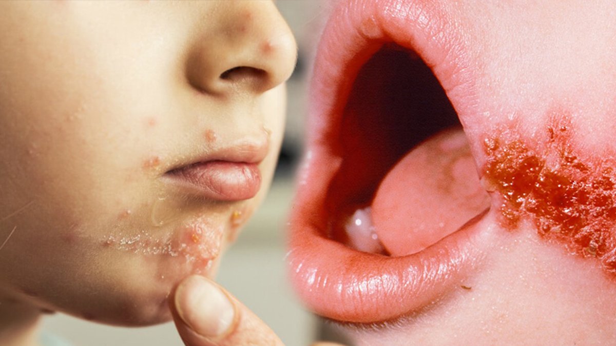 Çocuklarda görülen İmpetigo hastalığı nedir? Doğal yöntemlerle tedavisi yapılır mı?