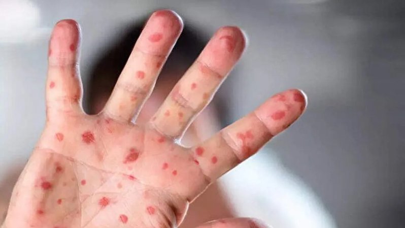 Maymun Çiçeği: Belirtileri, Tedavisi ve Korunma Yöntemleri