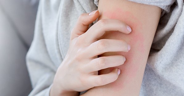 Uyuz Belirtileri: Ciltteki Kaşıntının Sebebi