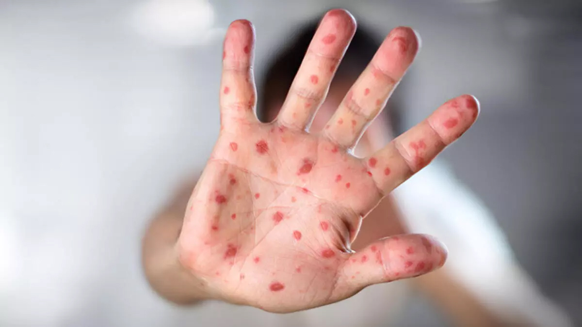 Uzmanlardan özellikle 'İstanbul' için uyarı: Bir yıllık artış bir ayda oldu