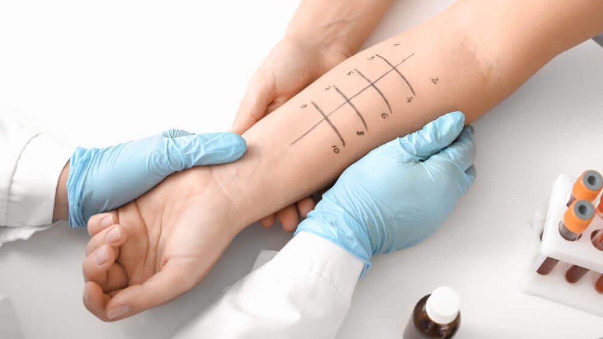 Kanda Alerji Testi Sonuçları Nasıl Yorumlanır?