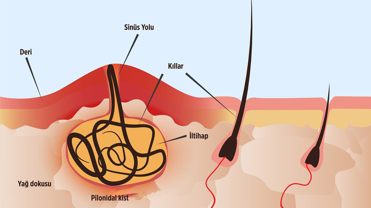 Kuyruk sokumunda kıl dönmesi nasıl geçer?