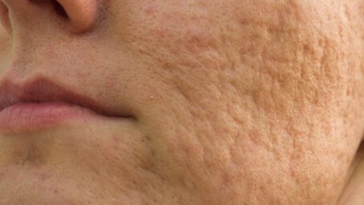 Sivilce izleri nasıl geçer?