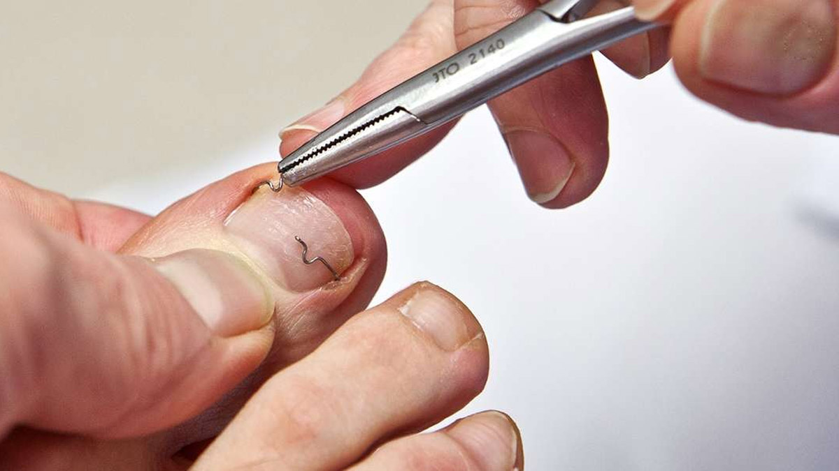 Tırnak batması evde nasıl geçer?