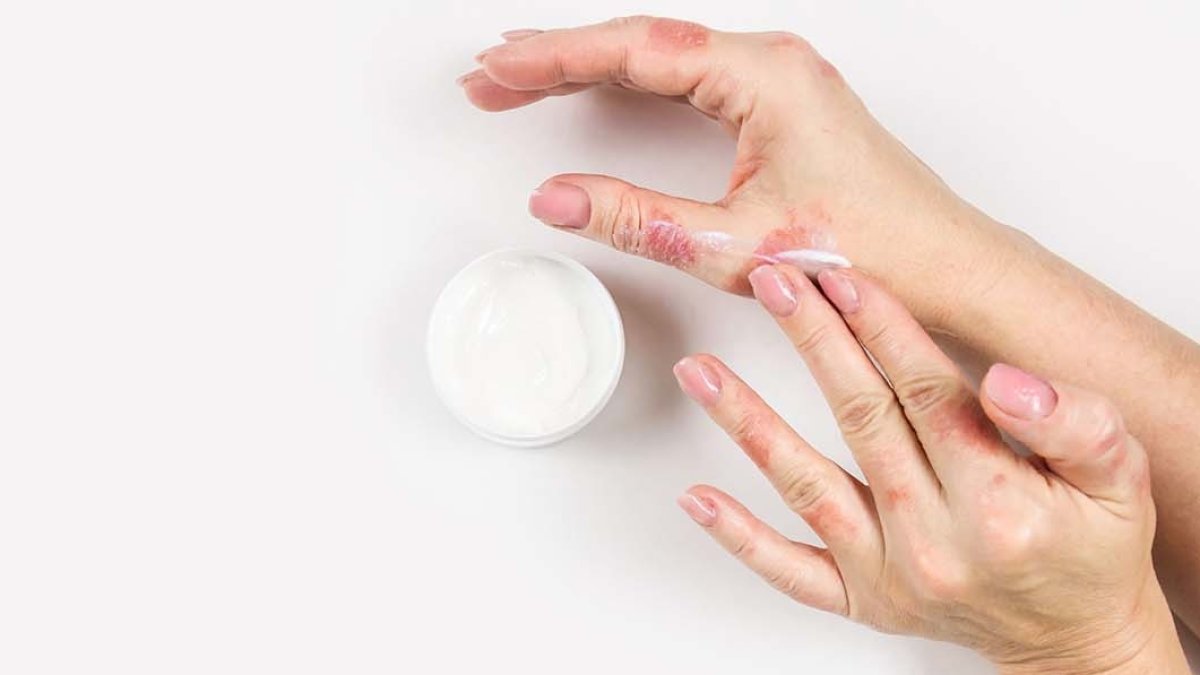 Egzama Nasıl Geçer: Egzama Belirtileri, Nedenleri, ve Tedavi Yöntemleri