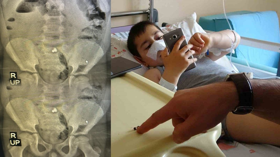 Yedi yaşındaki Miraç'ın bağırsaklarından mıknatıs çıktı: Organları üç yerden delindi