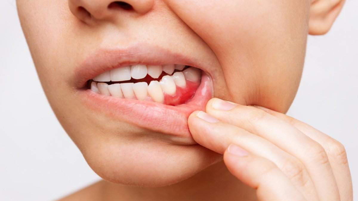 20'lik diş eti şişmesi nasıl geçer?