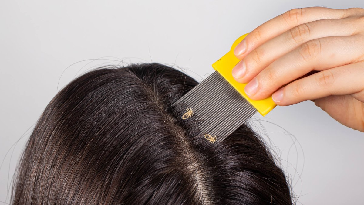 Bit Nasıl Geçer: Tedavi Yöntemleri ve Önleme Yolları