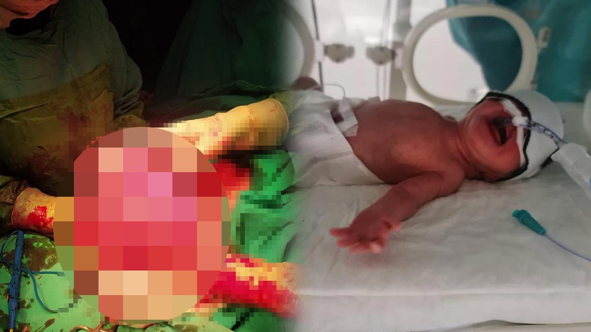 Tam 5 kilo çıkarıldı, doktorlar bile şaştı kaldı! 6,5 aylık doğan şanssız bebeğin talihi döndü