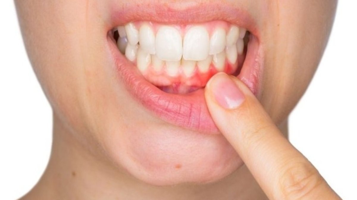 Diş Eti Ağrısı: Sebepleri, Belirtileri, Tedavisi ve Önleme Yolları
