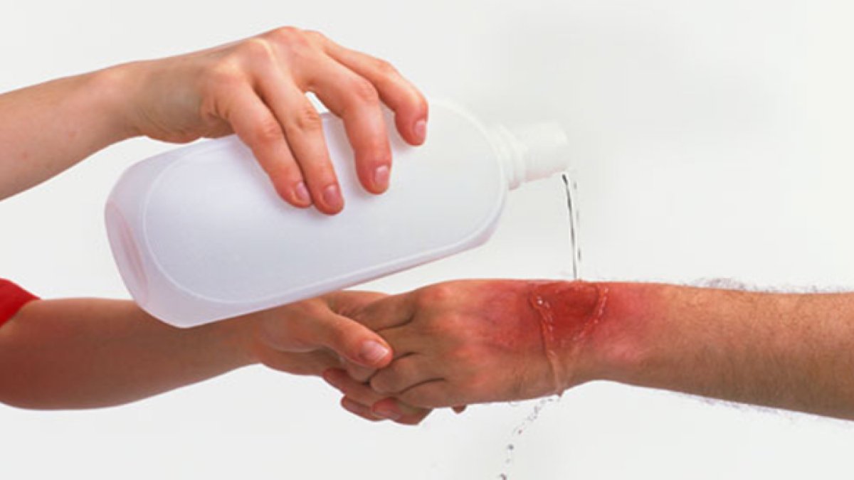 2. Derece Yanık: Belirtileri, Nedenleri ve Tedavisi