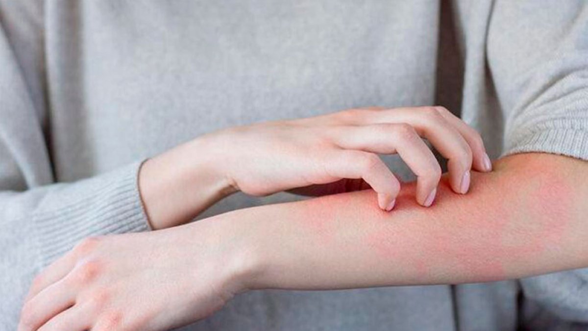 Uyuz Nedir ve Neden Olur?