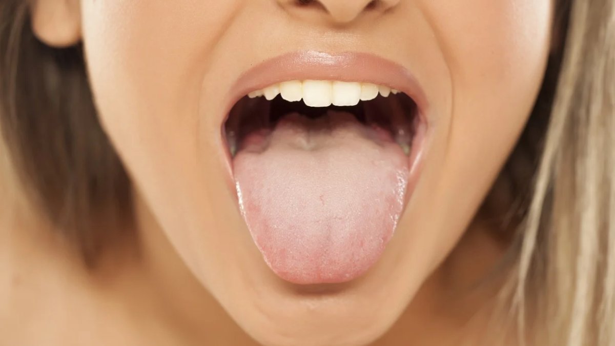 Dil Yarası Neden Olur: Sebepler ve Tedavisi