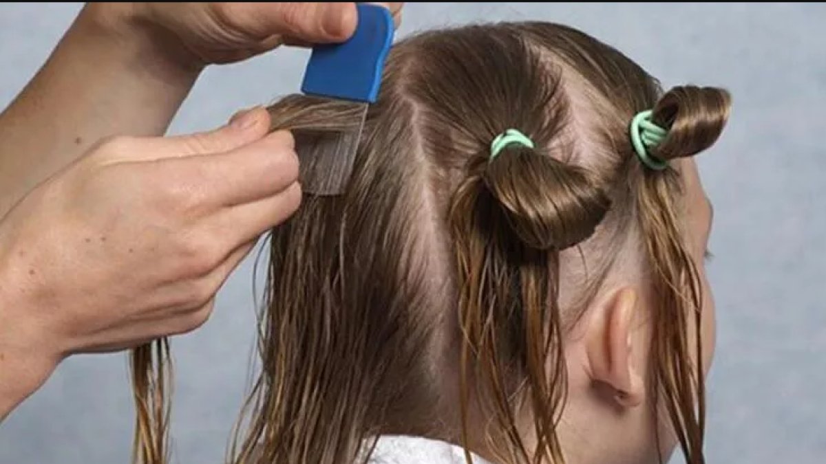 Rüyada Bitlendiğini Görmek: Hijyen ve Anlam