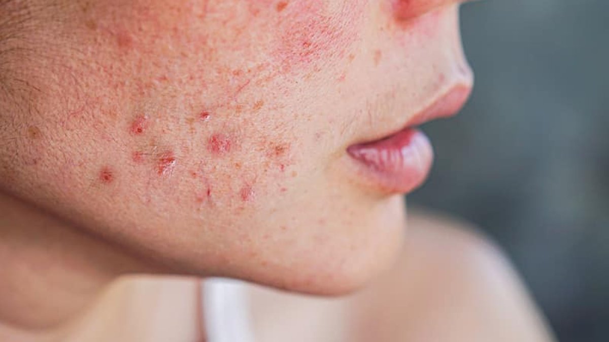 Cilt Lekelerine Ne İyi Gelir?