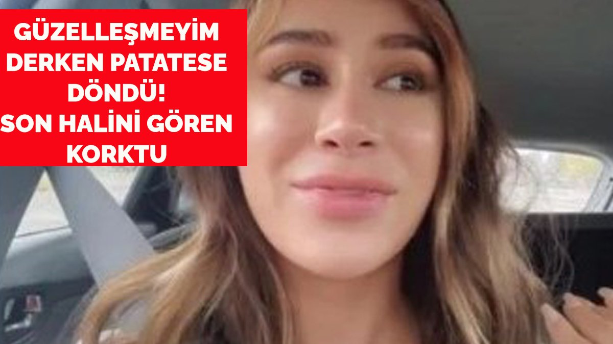 Güzelleşeyim derken patatese döndü! İşte kadının korkunç sonu