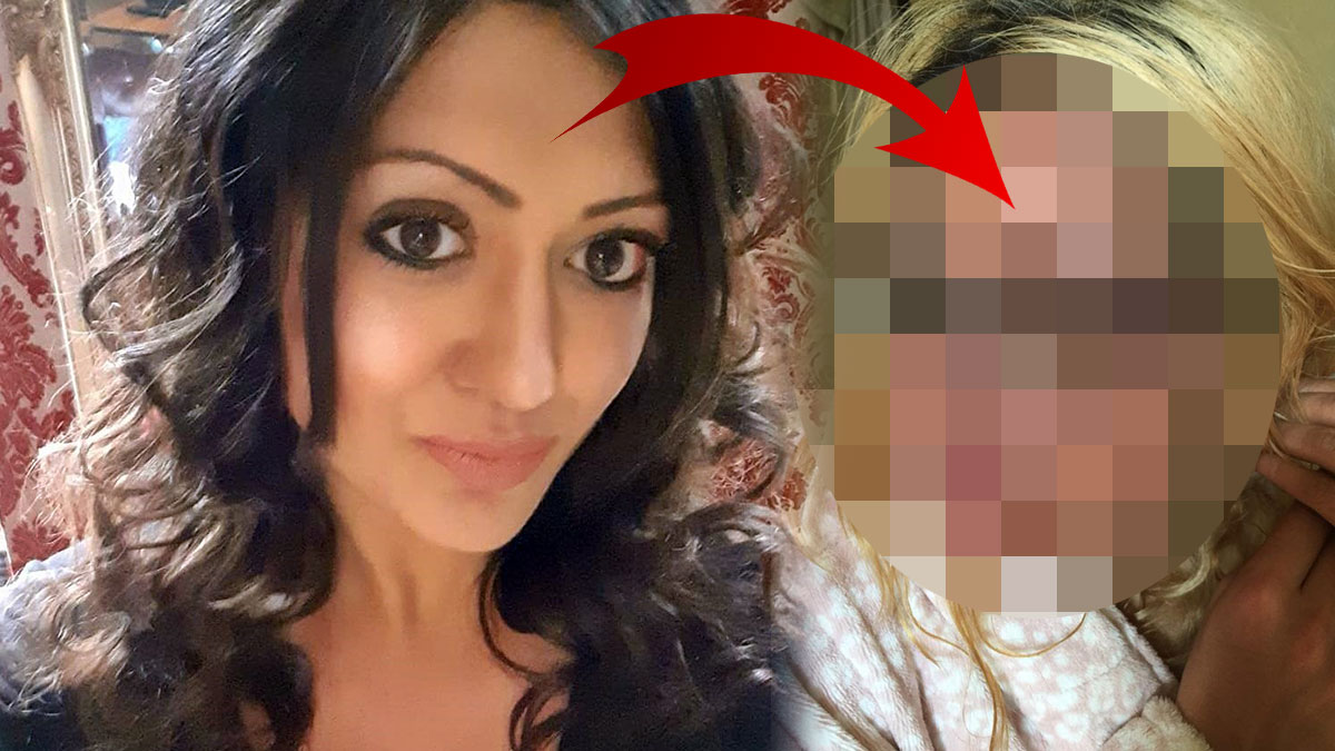 Yumurtayı mikrodalgada pişirmeye çalışırken felaketi yaşadı! Yüzüne kimse bakamıyor, asla eskisi gibi olmayacak