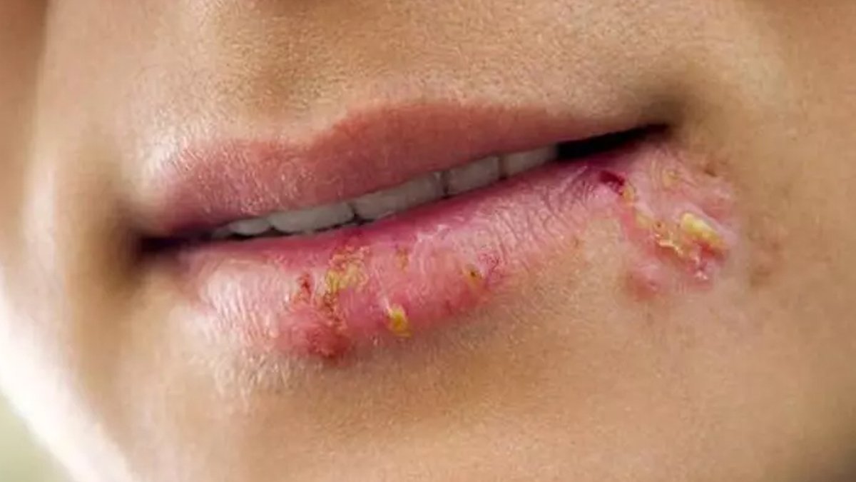 Uçuğa Ne İyi Gelir?