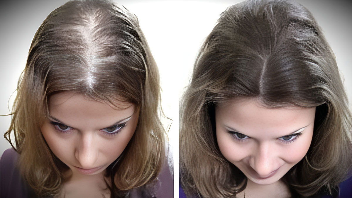 Облысение у женщин фото до и после