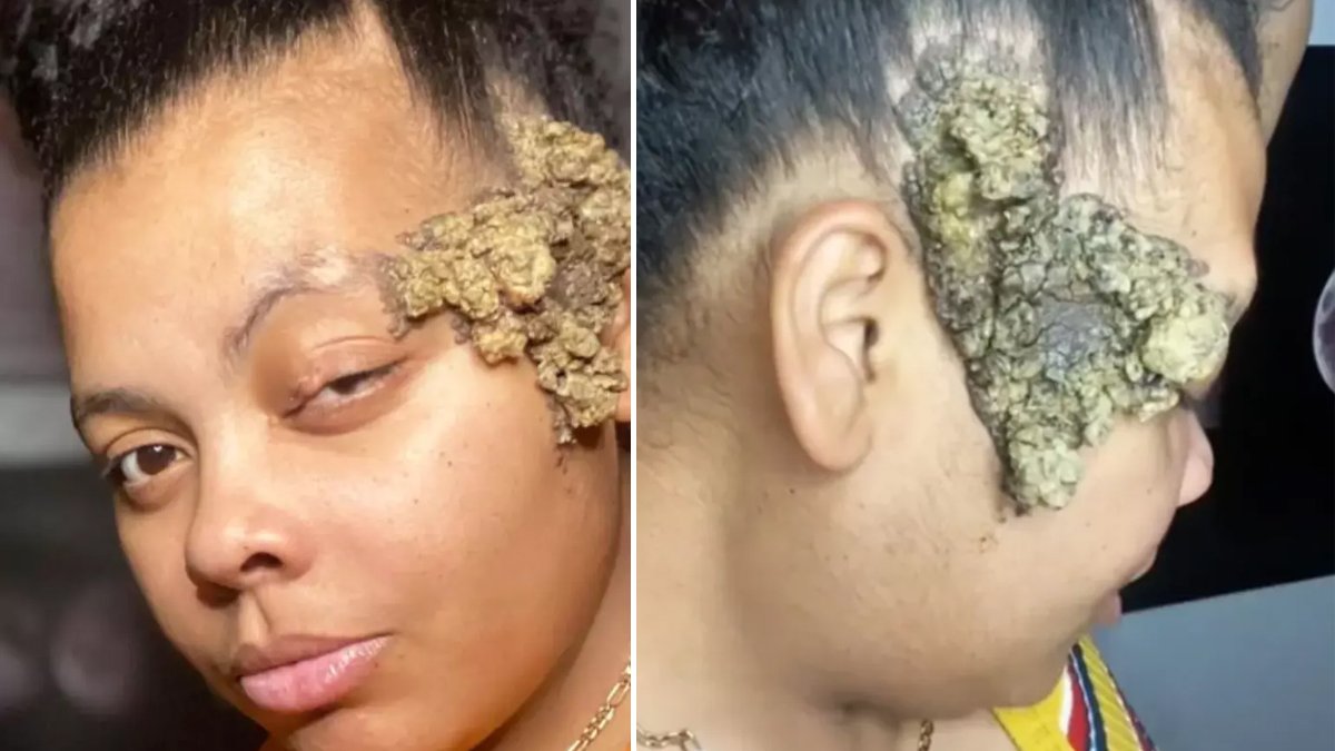 Doğum lekesi sandı şoke eden gerçeği hastanede öğrendi! Böyle hastalığı Allah düşman başına vermesin