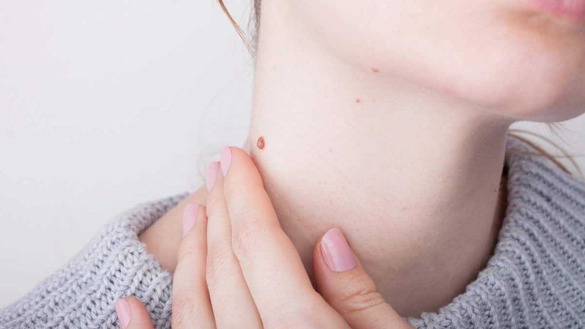 Siğile Ne İyi Gelir?