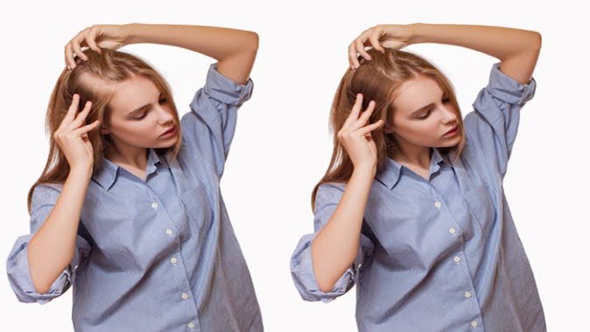 Kellik, saç dökülmesine mucize formül! Saçlarınız at yelesi gibi uzayacak! Hem ucuz hem etkili