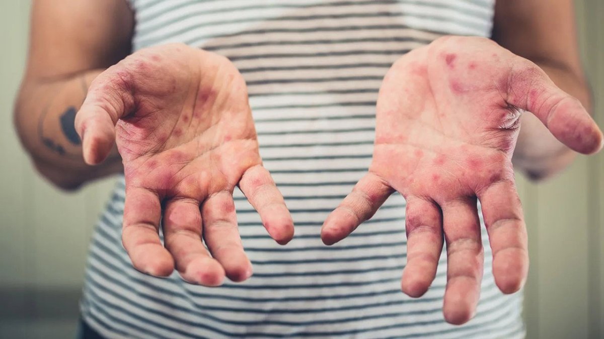 Prof. Dr. Bülent Ertuğrul kızamık salgınının nedenlerini açıkladı: Ülkemize kontrolsüz bir giriş var, hiçbir şey bilmiyoruz