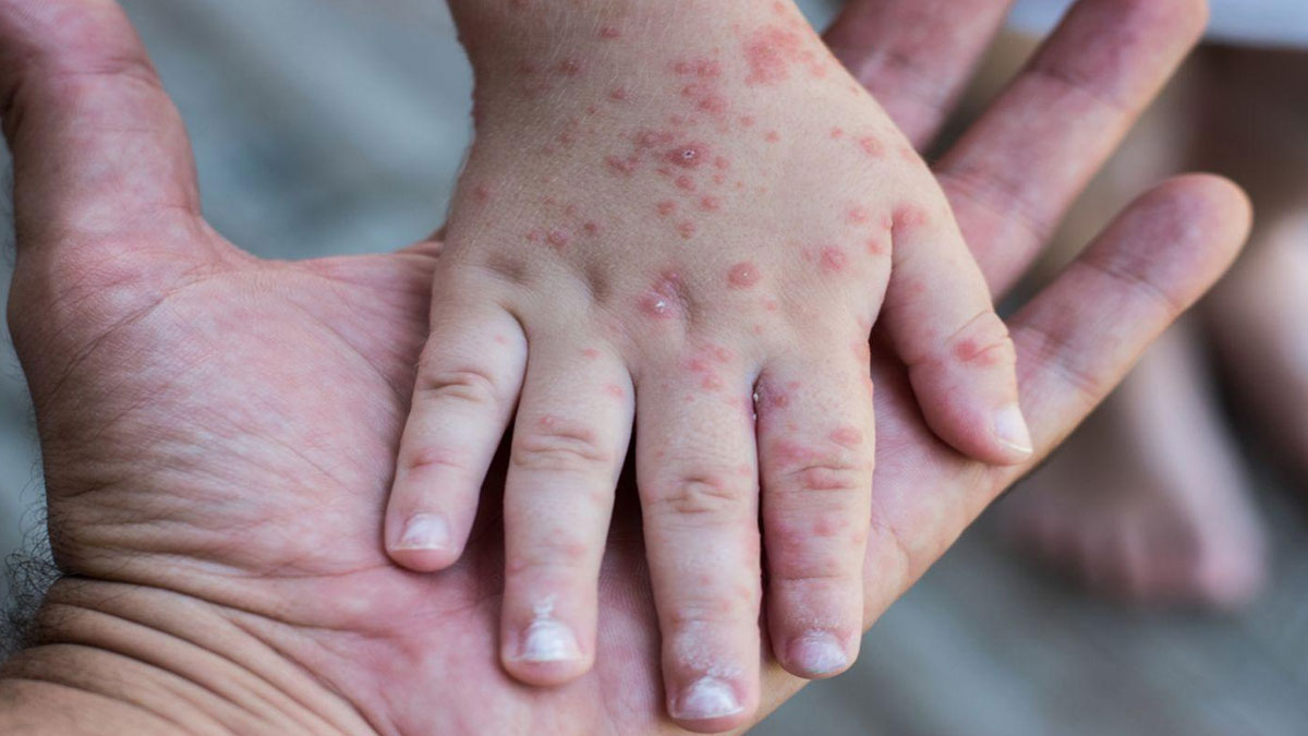 CHP'li vekilden korkutan iddia: Kızamık vakaları saklanıyor mu?