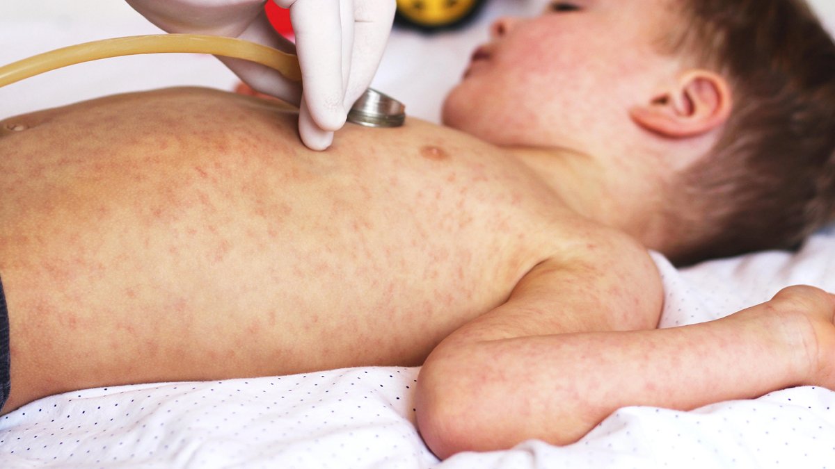 TTB’den kızamık uyarısı: Aşılı olup olmadığına bakılmaksızın...