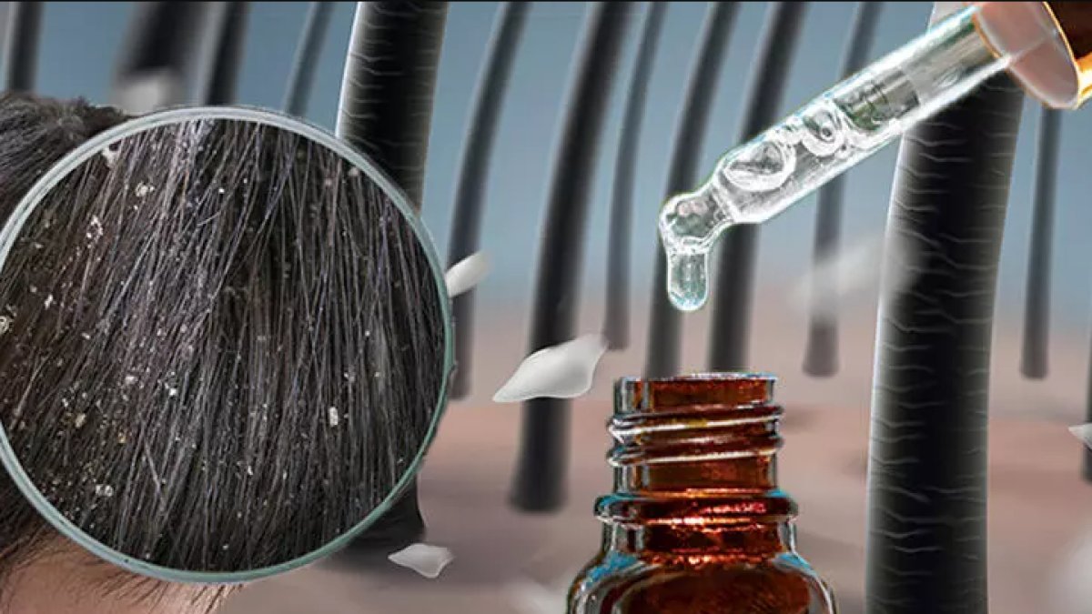 Saçtaki Kepeğe Ne İyi Gelir? - Doğal ve Etkili Çözümler